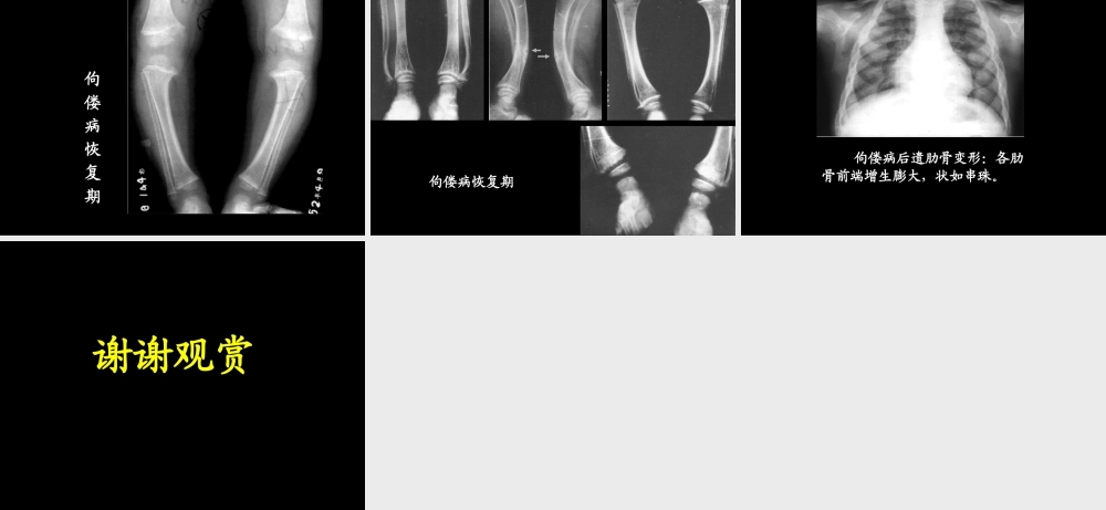 佝偻病影像.ppt