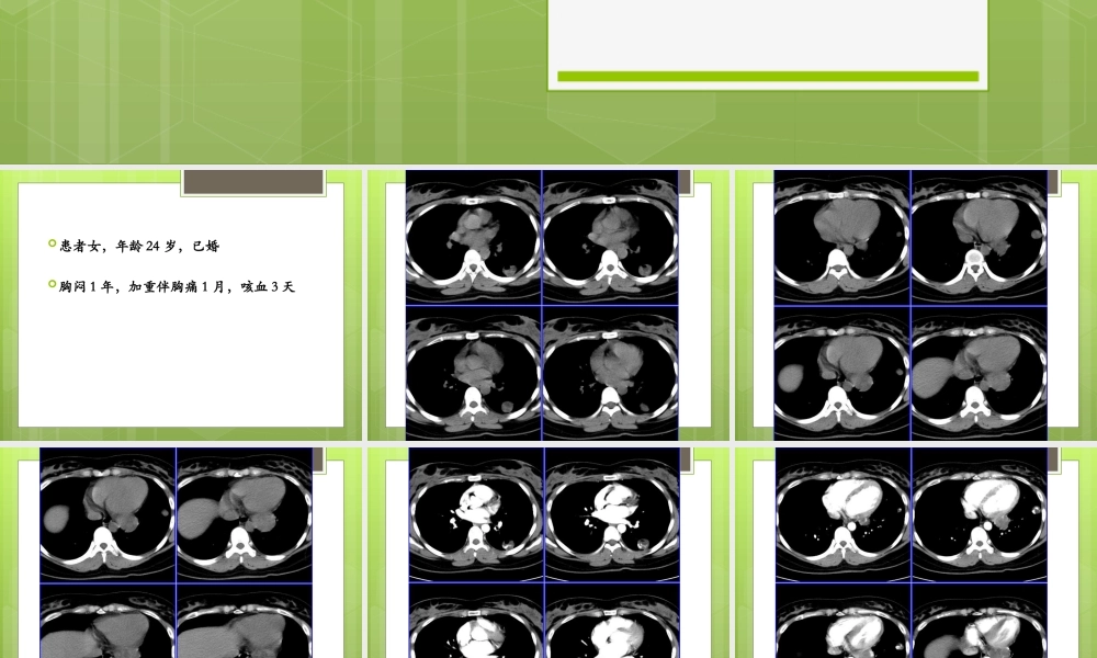 侵袭性葡萄胎肺转移.ppt