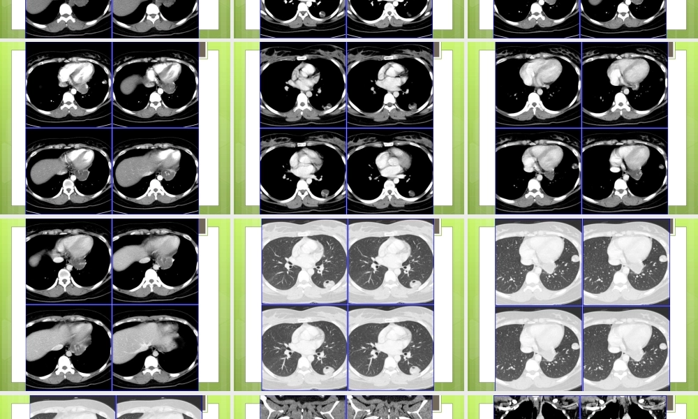 侵袭性葡萄胎肺转移.ppt