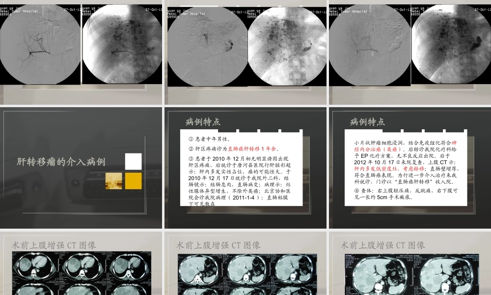 介入病房典型病例.ppt