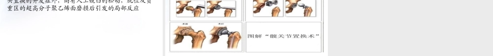 人工全髋关节置换术.ppt