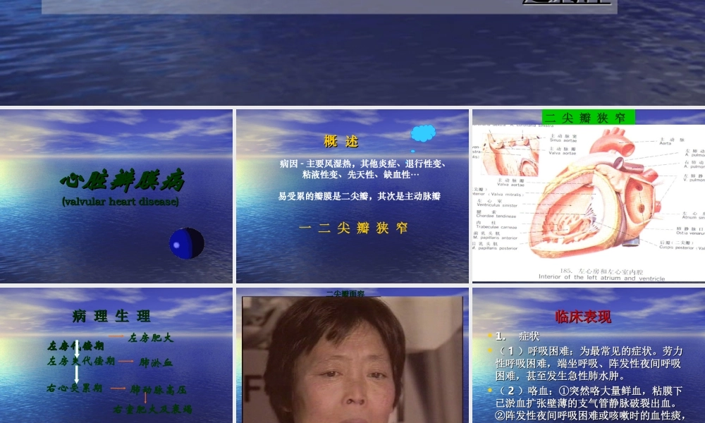 二尖瓣狭窄的心脏体征.ppt