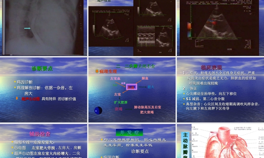 二尖瓣狭窄的心脏体征.ppt