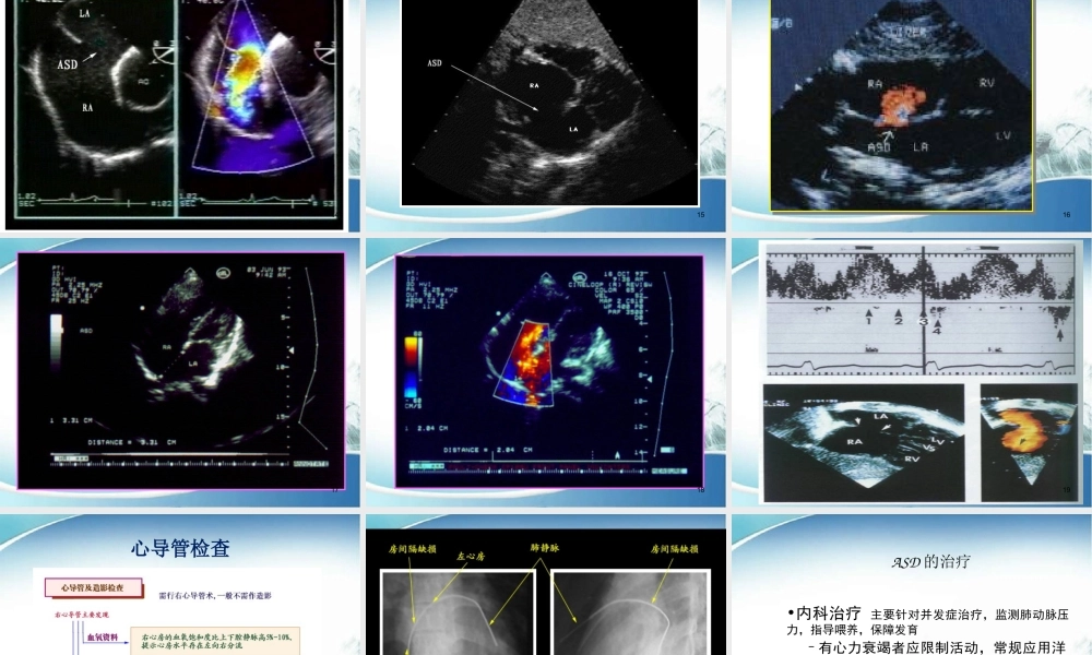 儿童先天性心脏病.ppt