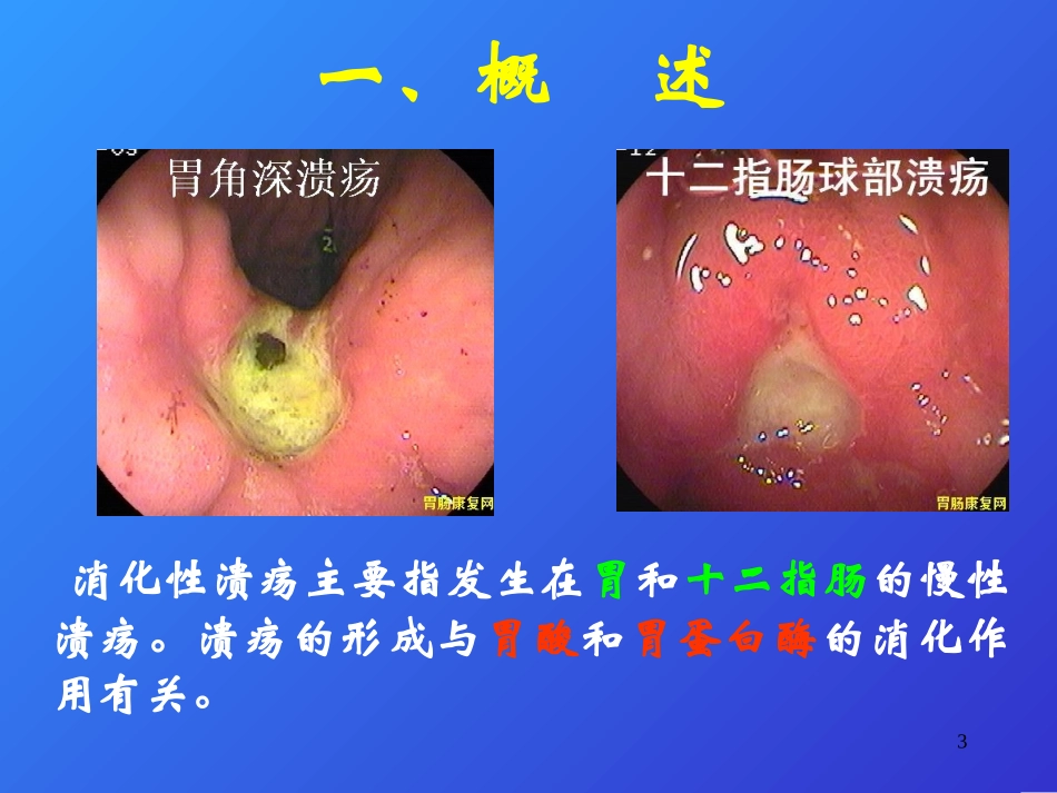 消化性溃疡08905.ppt_第3页