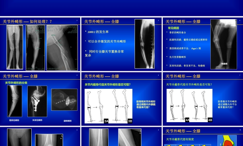 关节外畸形全膝.ppt