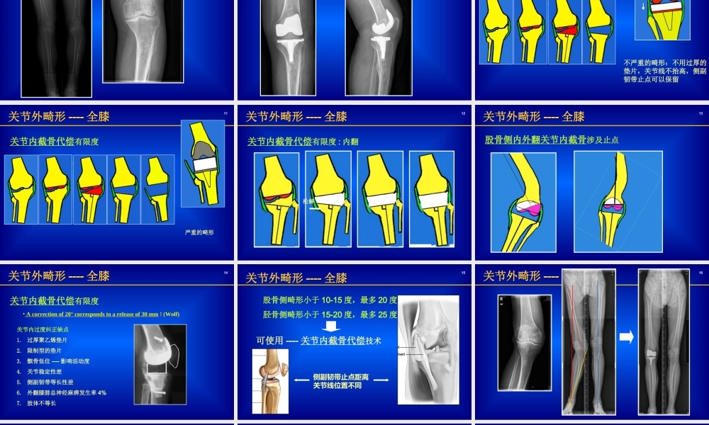 关节外畸形全膝.ppt