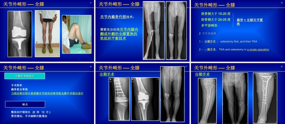 关节外畸形全膝.ppt