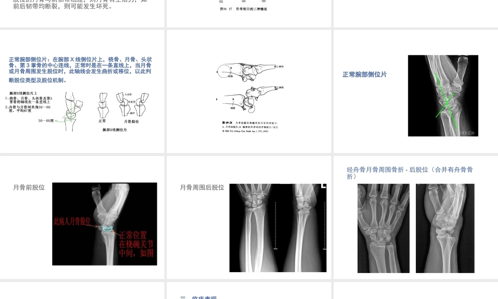 月骨脱位与月骨周围脱位.ppt