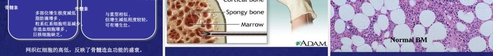 再生障碍性贫血教学PPT.ppt
