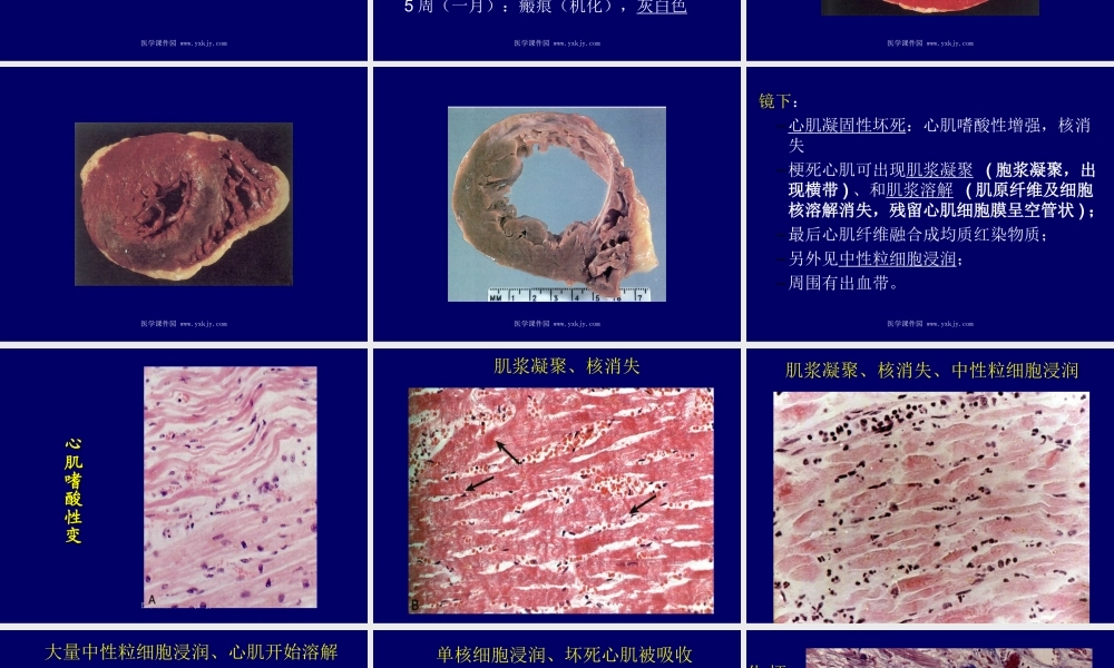 冠状动脉心脏病.ppt