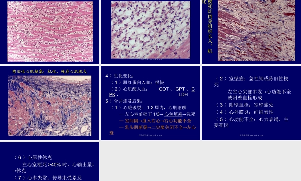 冠状动脉心脏病.ppt