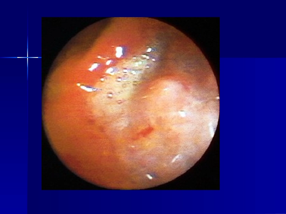 消化性溃疡20.ppt_第1页