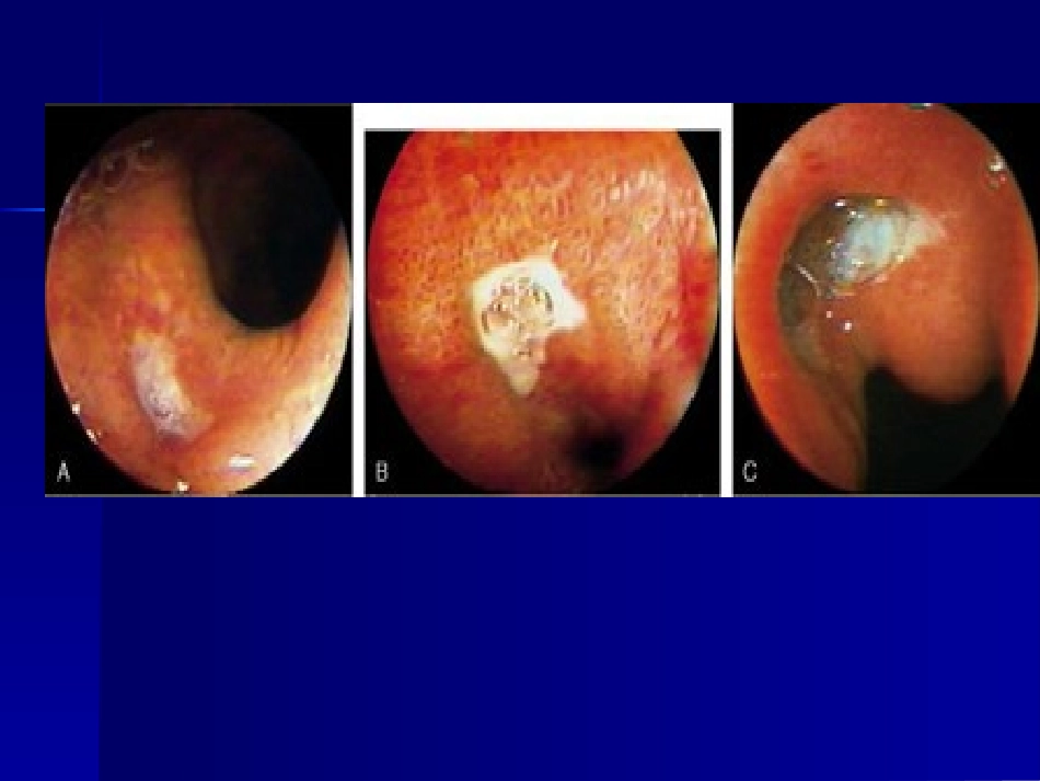 消化性溃疡20.ppt_第2页