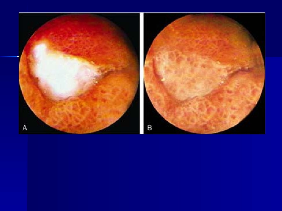 消化性溃疡20.ppt_第3页