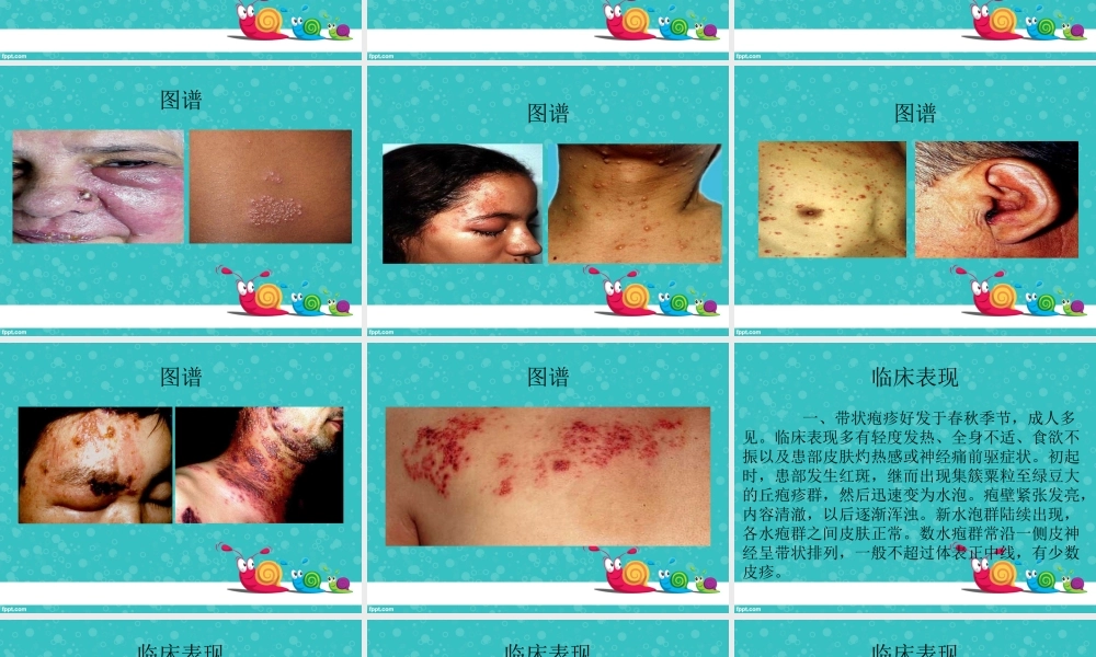 带状疱疹健康讲座.ppt