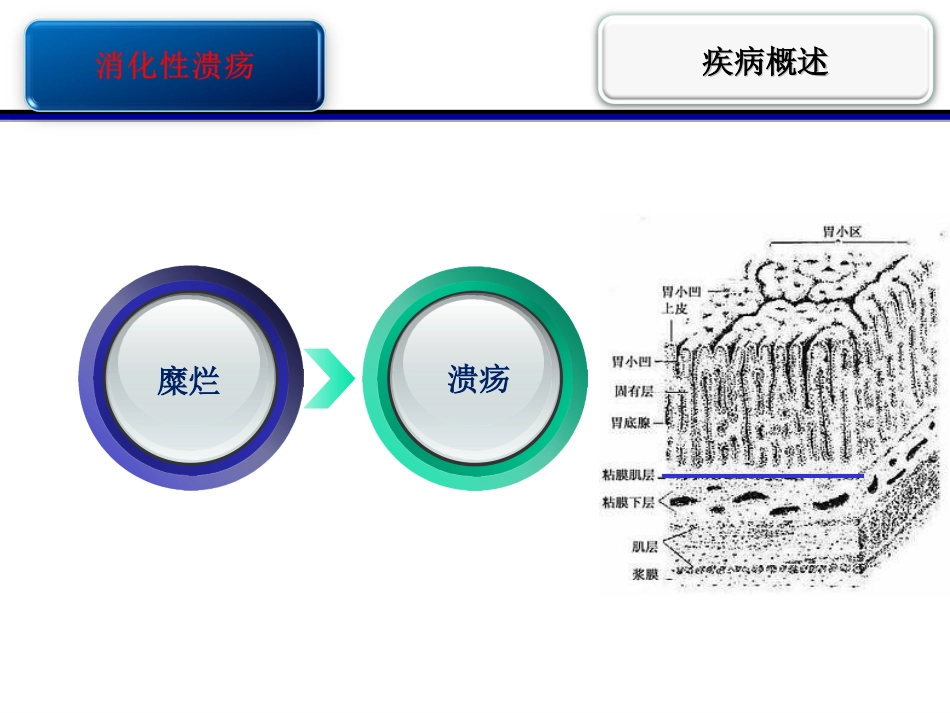消化性溃疡护校.ppt_第3页