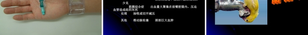 桡动脉穿刺技巧、常见问题和并发症的处理.ppt