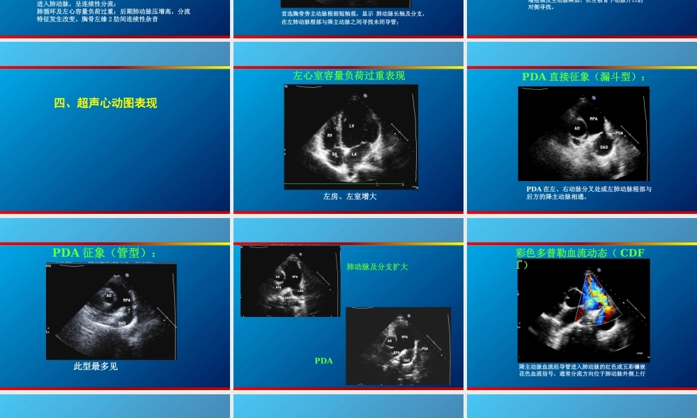 动脉导管未闭、主动脉狭窄.ppt