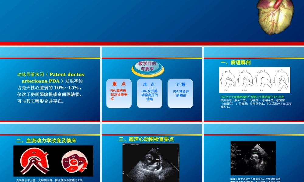 动脉导管未闭、主动脉狭窄超声.ppt