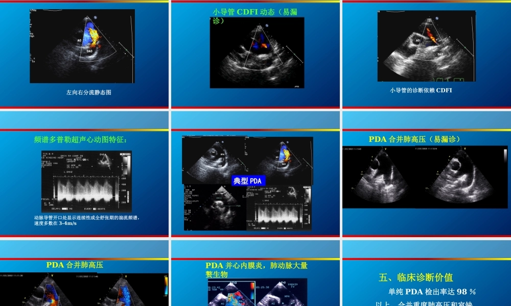 动脉导管未闭、主动脉狭窄超声.ppt