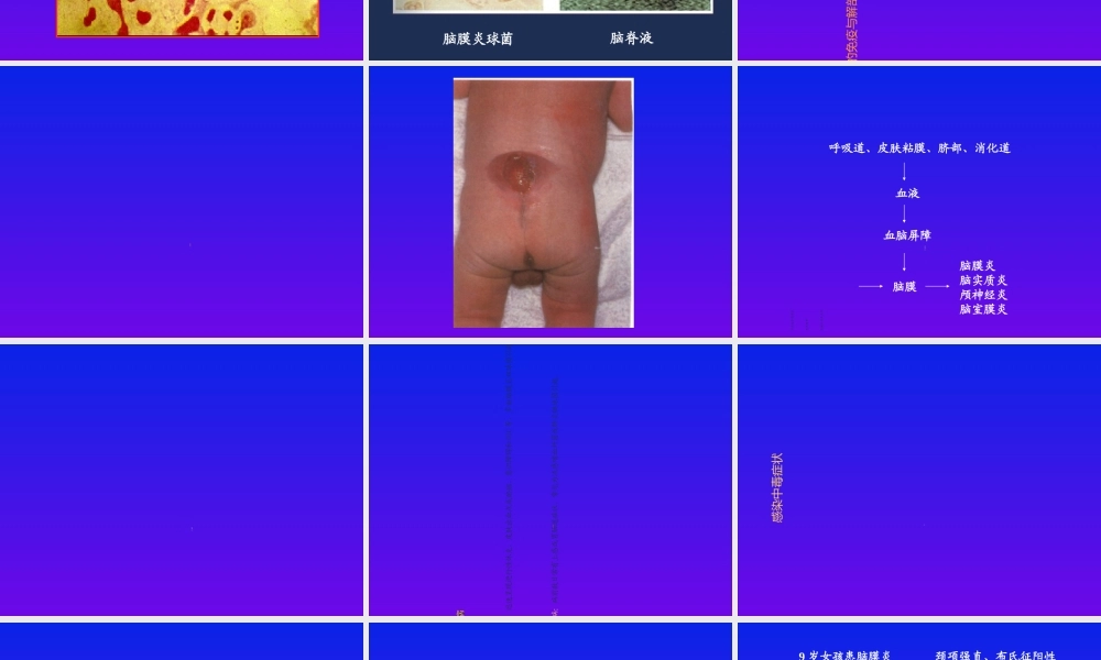 化脓性脑膜炎修改-PPT文档资料.ppt