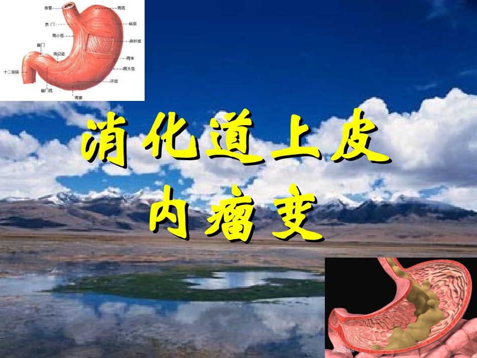 消化道上皮内瘤变.ppt_第1页