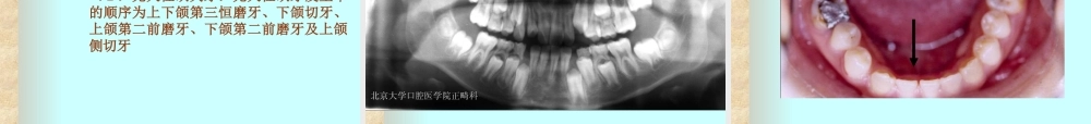 北医正畸-第3章--错合畸形的病因.ppt