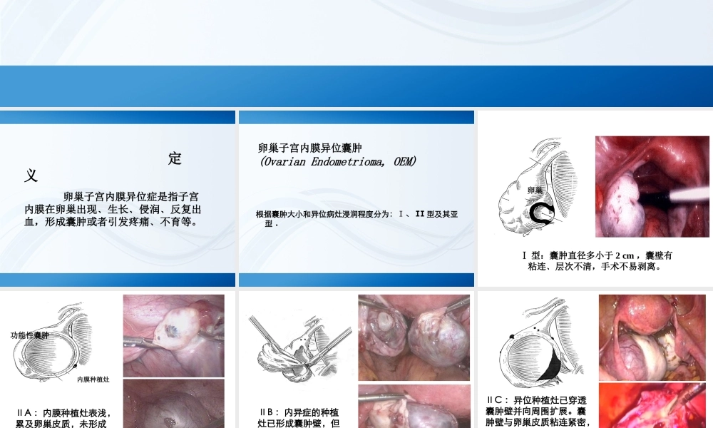 卵巢子宫内膜异位症.ppt