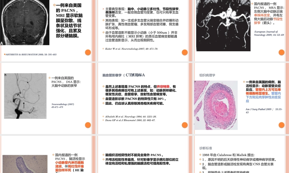 原发性中枢神经系统血管炎.pptx