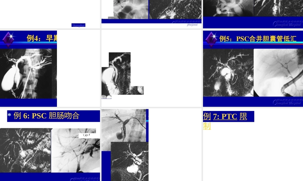 原发性硬化性胆管炎.pptx