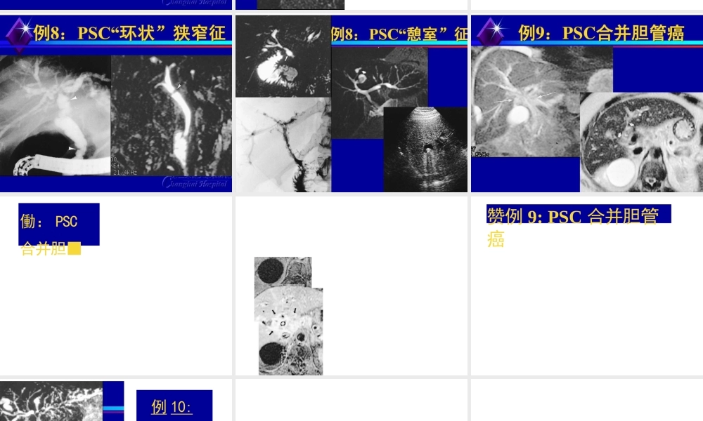 原发性硬化性胆管炎.pptx