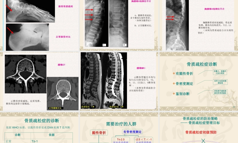 原发性骨质疏松症的诊治及康复.ppt
