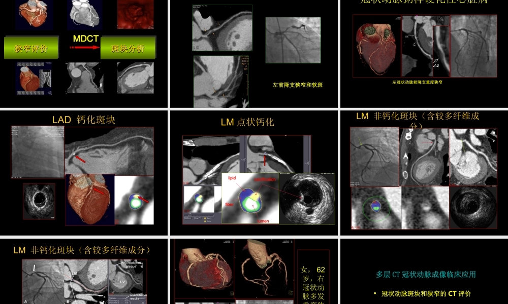 多排螺旋CT在冠状动脉成像中的应用.ppt