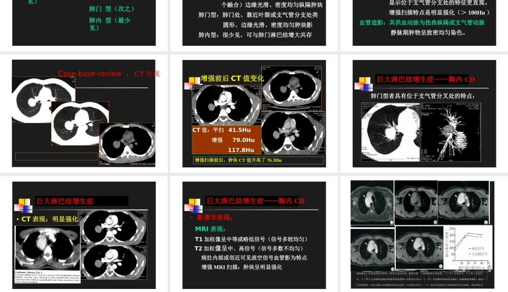 巨淋巴结增生症.ppt