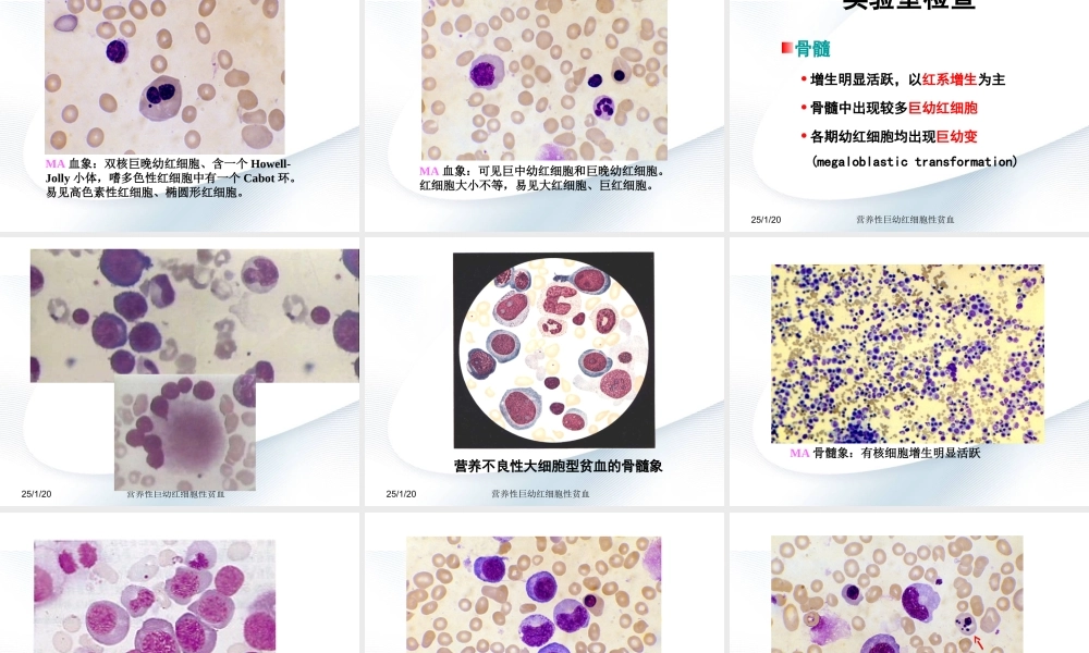 巨幼细胞性贫血.ppt