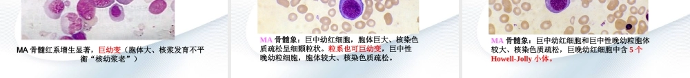 巨幼细胞性贫血.ppt