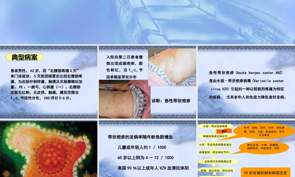 带状疱疹诊治.ppt