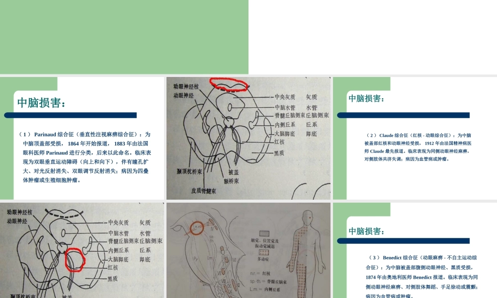 常见的脑干损害综合征.ppt