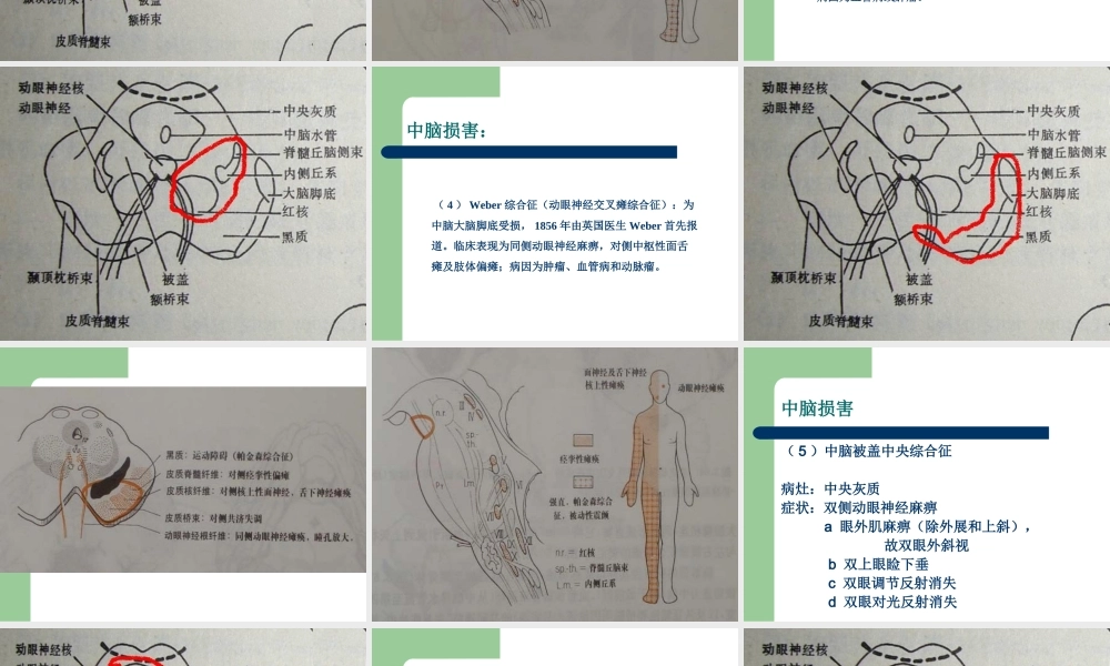 常见的脑干损害综合征.ppt