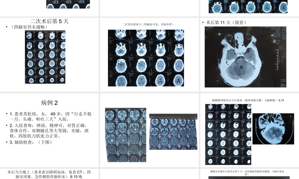 幕下术后发生急性梗阻性脑积水的思考与处理.ppt
