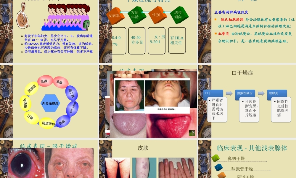 干燥综合征教学查房.ppt