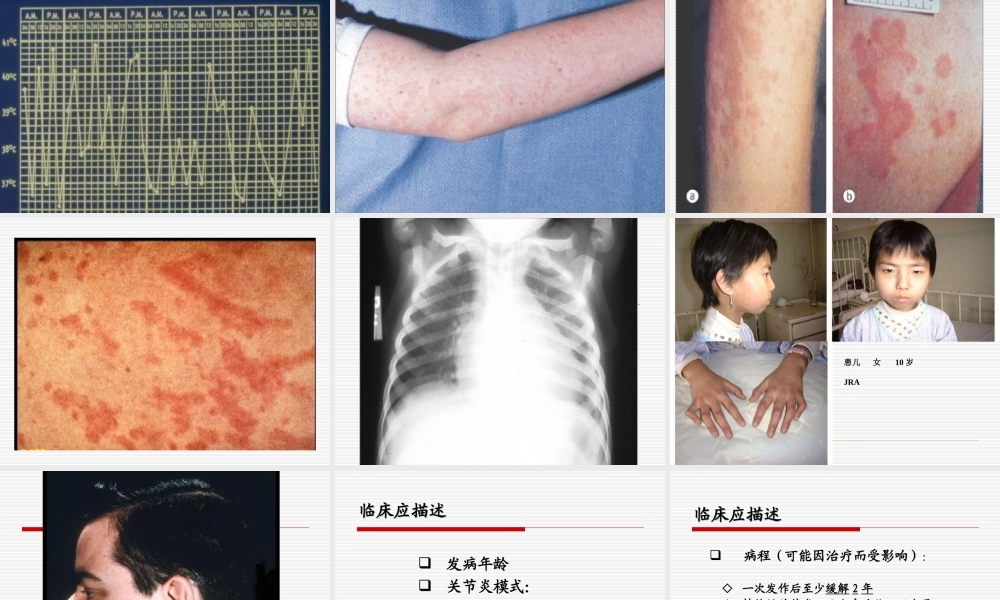 幼年特发性关节炎.ppt.ppt