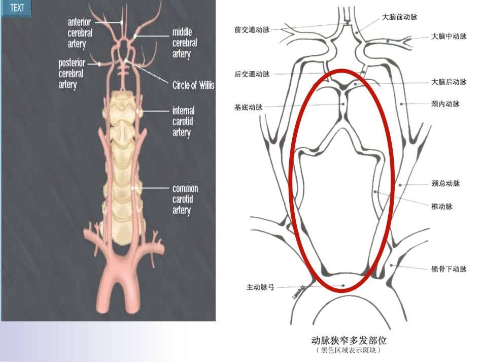 眩晕与后循环缺血分析.ppt_第3页