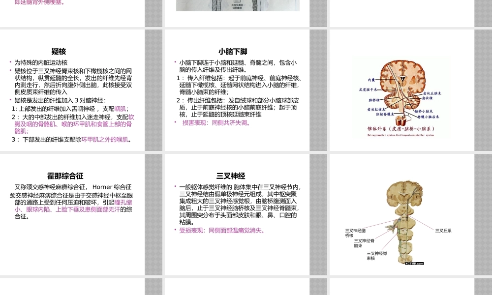 延髓背外侧综合症.pptx