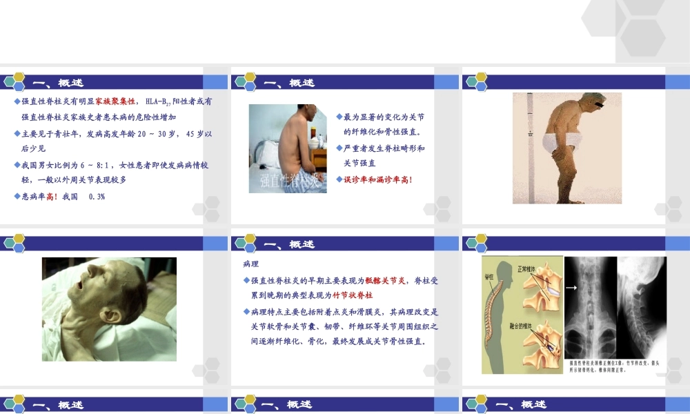强直性脊柱炎的概述..ppt