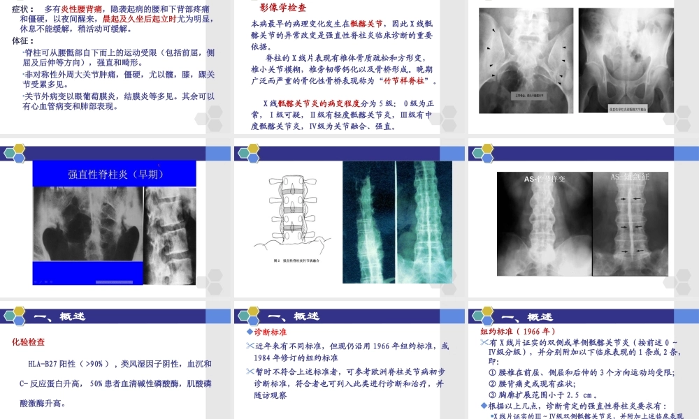 强直性脊柱炎的概述..ppt