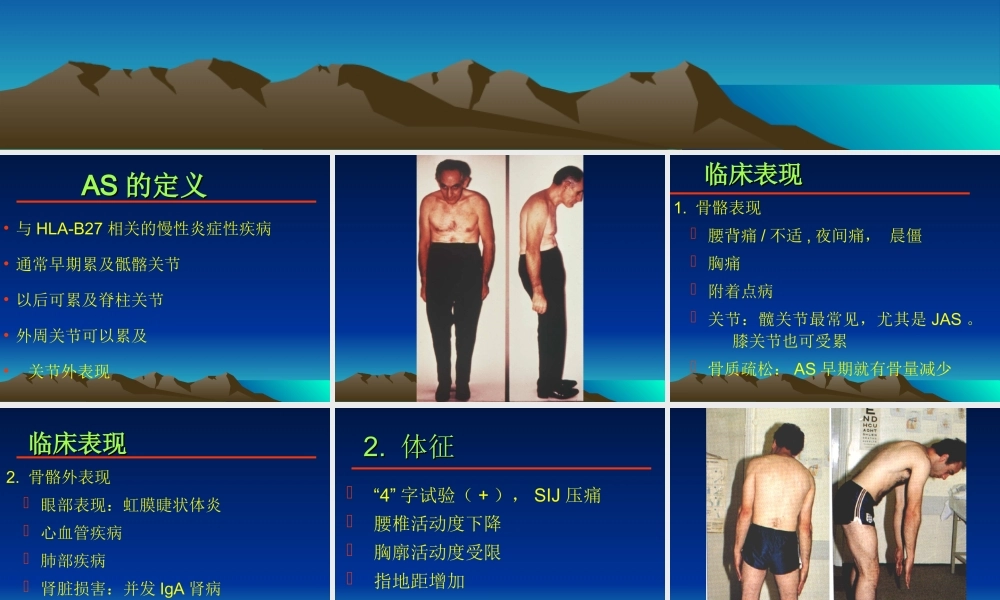 强直性脊柱炎的诊疗经验.ppt