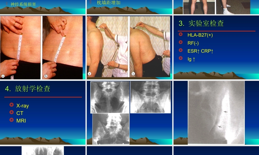 强直性脊柱炎的诊疗经验.ppt