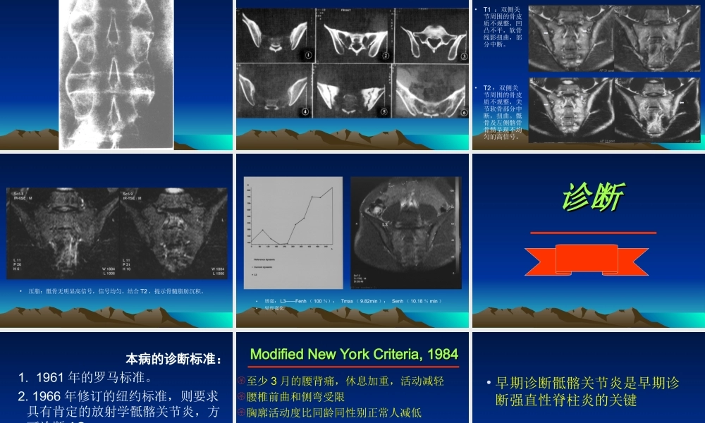 强直性脊柱炎的诊疗经验.ppt
